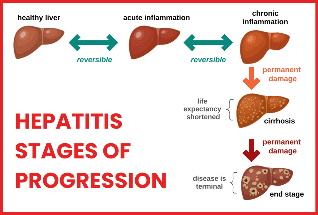 Can Viral Infections Like Hepatitis Cause Long-Term Liver Damage