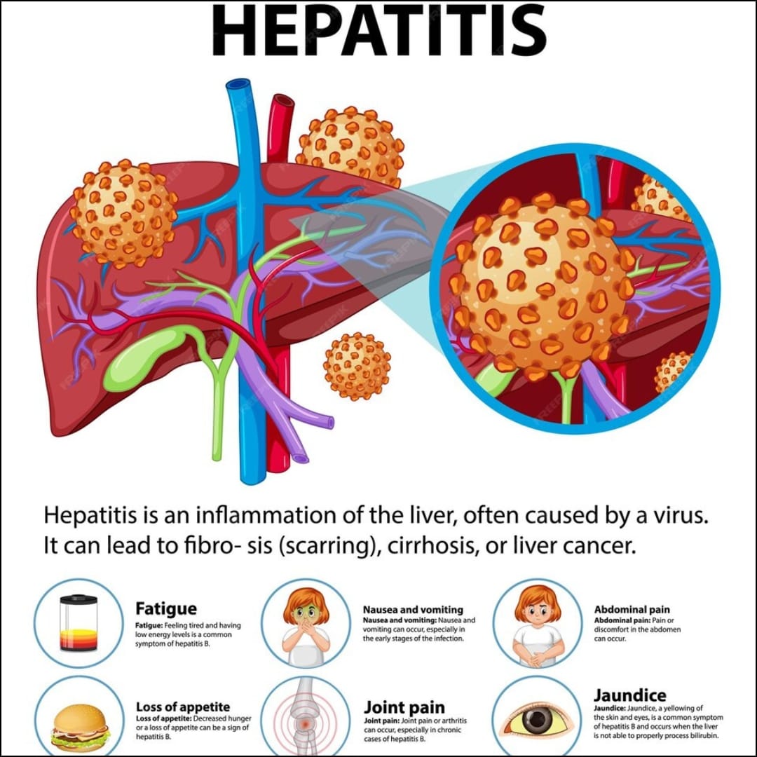 Can Viral Infections Like Hepatitis Cause Long-Term Liver Damage