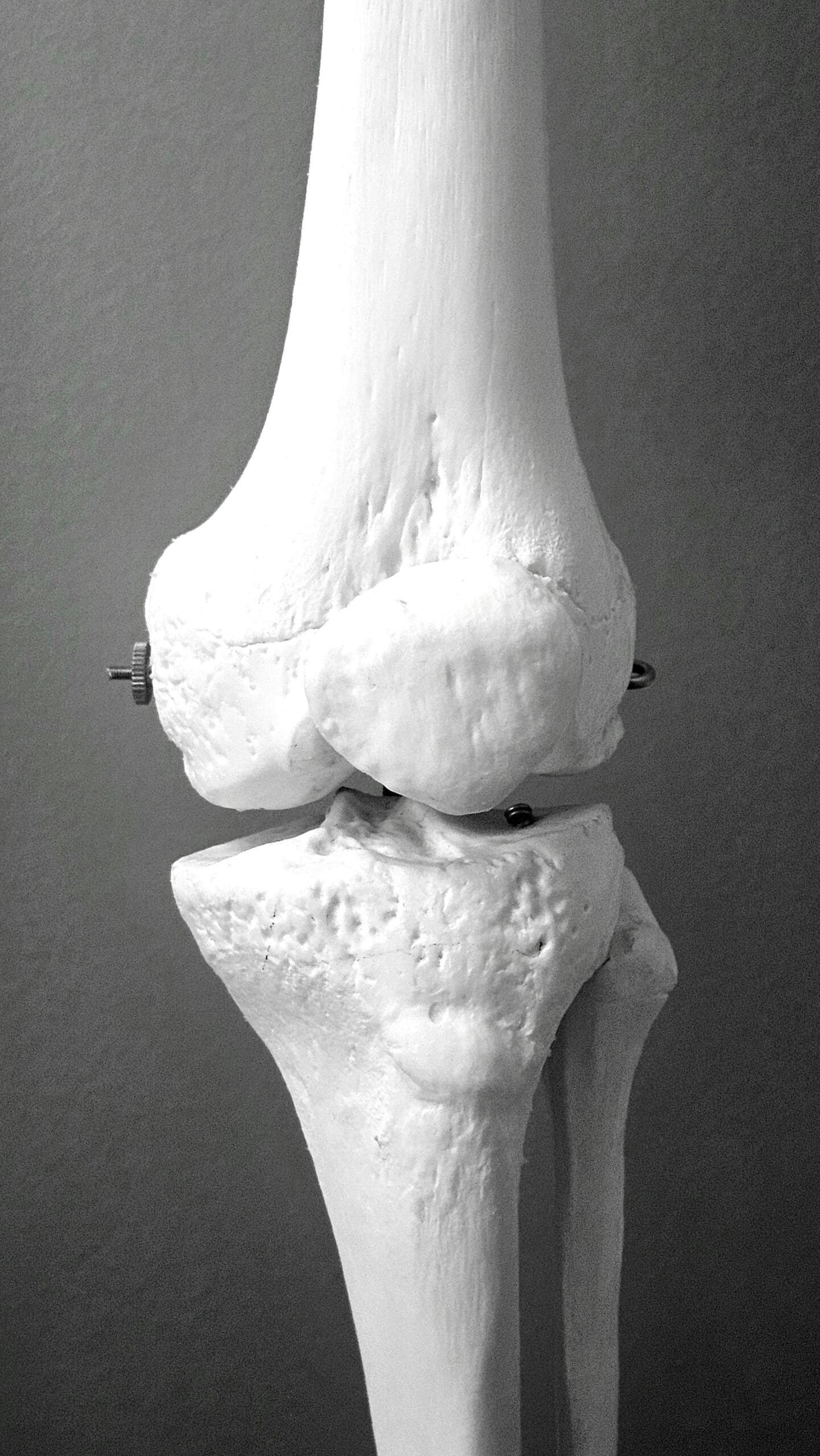 Exploring the Long-Term Effects of Menopause on Bone Health